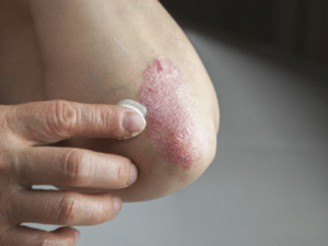 Manifestations du rhumatisme psoriasique : tuméfaction de l'articulation, rougeur, raideur, douleur, ...