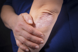Le psoriasis se présente sous différentes formes : plaques, gouttes, pustules, atteinte des ongles, ...