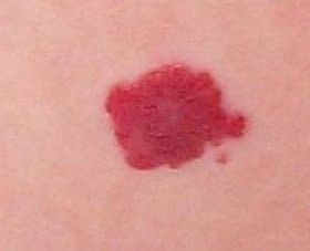 Angiome, une anomalie vasculaire se présentant sous forme de couleur rouge à bleutée sur la surface de la peau