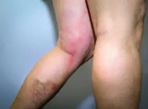 thrombophlébite
