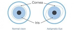 astigmatisme