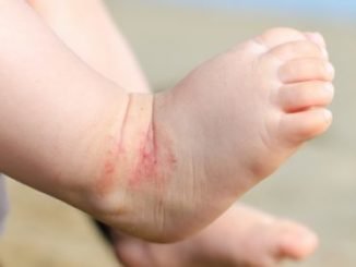 eczéma