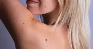 nævus