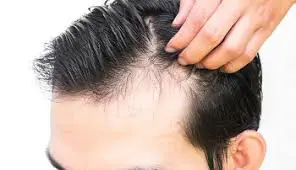 Perte de cheveux pour les hommes