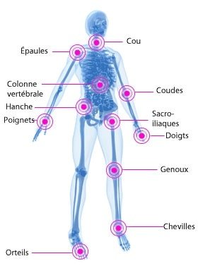 Rhumatisme psoriasique