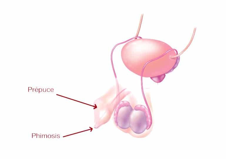 erekció a phimosis után)