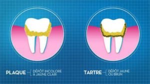 tartre